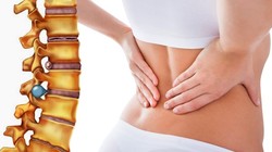 Ảnh minh họa bệnh thoát vị địa đệm cột sống lưng