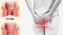 Trĩ gây ảnh hưởng tới sinh hoạt hàng ngày của người bệnh.