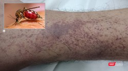 Bệnh nhân bị xuất huyết nặng dưới da do mắc sốt xuất huyết trên nền bệnh tan máu bẩm sinh.