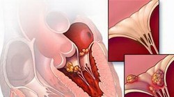 Ảnh minh họa bệnh tim mạch