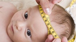 Bệnh nhi mắc não úng thủy (Ảnh minh họa)