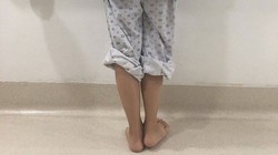 Sau lần phẫu thuật cách đây 4 năm, nữ sinh Đỗ Thị Kim C. phải chịu đôi chân lệch nhau 2 cm, dáng đi tập tễnh khiến em tự ti.