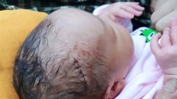 Vừa mới ra đời, em bé này đã phải chịu vết khâu dài 6 mũi.