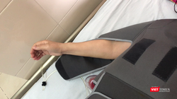 Cánh tay của cô Th. hồi phục sau khi được thay xương bả vai (Ảnh: bác sĩ Phạm Sơn Tùng)