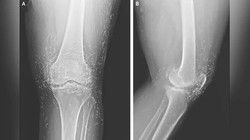 Ảnh chụp X-quang cho thấy hàng trăm sợi chỉ vàng trong đầu gối của nữ bệnh nhân. Ảnh: OddCentral.