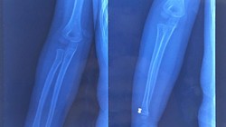 Hình ảnh đạn súng hơi găm trong tay bệnh nhi