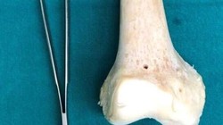 Xương được sử dụng để thay khớp gối cho bệnh nhân