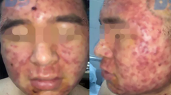 Sử dụng thuốc nam, nam thanh niên bị mụn chi chít. (Ảnh bệnh viện cung cấp)
