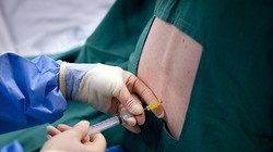 Gây tê tủy sống 