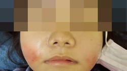 Khuôn mặt sưng tấy của người bệnh sau khi tiêm filler