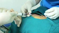 Các bác sĩ tiến hành phẫu thuật cho bệnh nhân. Ảnh: Bệnh viện E. 