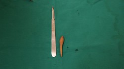 Đuôi của bé gái 5 tháng tuổi. Ảnh: BVCC