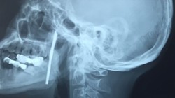 Ảnh chụp X-quang bệnh nhân bị thanh sắt cắm xuyên cổ. Ảnh: BVCC 