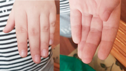 Hình ảnh búp ngón tay của bệnh nhi sau mổ. Ảnh: BVCC