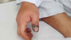 Ngón cái bàn tay phải của bệnh nhân bị rắn cắn sưng đỏ, có dấu hiệu hoại tử. Ảnh: BVCC