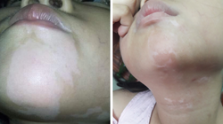 Bệnh nhân bị bệnh bạch biến sau 2 tháng làm phương pháp ghép tế bào thượng bì tự thân. Ảnh: Bệnh viện Da liễu Trung ương. 