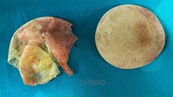 Túi ngực vỡ của chị V. được lấy ra sau 5 năm phẫu thuật nâng ngực (Ảnh - Bệnh viện Hữu nghị Việt Đức) 