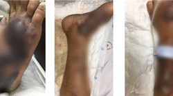 Chân của bệnh nhân bị nhiễm trùng máu nặng do loài vi khuẩn lạ (Ảnh: BVCC) 