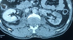 Phim chụp trước mổ của bệnh nhân D. (Ảnh: Bệnh viện Hữu nghị Việt Đức) 