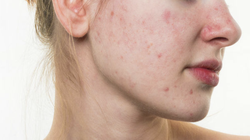 Mụn trứng cá là nỗi ám ảnh của nhiều chị em phụ nữ (Ảnh: BoldSky)  