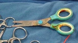 Chiếc kéo được lấy ra từ cổ bệnh nhi (Ảnh: BVCC) 