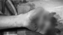 Bé T. đã mất 3 ngón tay do pin của quạt tích điện phát nổ (Ảnh: BVCC) 