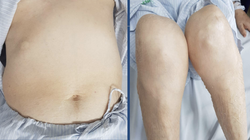 Bệnh nhân bị teo cơ tứ chi, béo bụng, rạn da vùng bụng, da mỏng, dễ xuất huyết vì lạm dụng corticoid để trị đái tháo đường. (Ảnh: BVCC) 