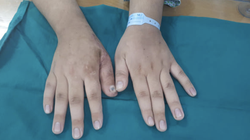 Bàn tay của bệnh nhân sau phẫu thuật (Ảnh: BVCC) 