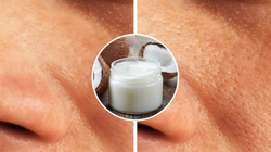 Bôi dầu dừa thay vì kem dưỡng ẩm có thể gây bít lỗ chân lông (Ảnh: BrightSide)