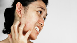 Tẩy da chết không đúng cách có thể khiến da bị tổn thương (Ảnh: Boldsky) 