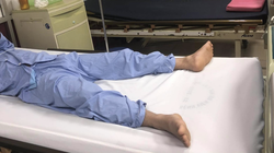 Bệnh nhân tự bẻ cong dương vật đã bình phục sau mổ (Ảnh: BVCC) 