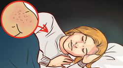 Da nổi mụn vì mặc quá ấm khi đi ngủ (Ảnh: Brightside) 