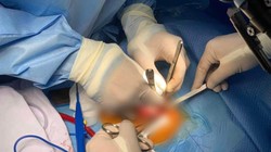 Các bác sĩ phẫu thuật cho bé (Ảnh - BVCC) 