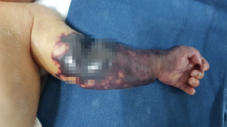 Hình ảnh cánh tay bé T. khi mới vào viện (Ảnh - BVCC) 