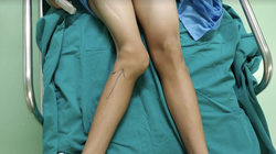 Khớp gối của thiếu niên 14 tuổi bị biến dạng (Ảnh - BVCC) 