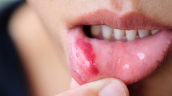 Tưởng chỉ là nhiệt miệng, nào ngờ phát hiện đang mắc ung thư lưỡi 