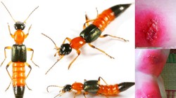 Những vết cắn của kiến ba khoang gây ra tổn thương nghiêm trọng cho da