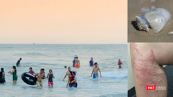 Vết thương do sứa cắn bị mẩn đỏ, ngứa rát