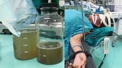 Dùng miệng hút dầu chạy máy xúc, bệnh nhân rơi vào tình trạng suy hô hấp, viêm phổi nặng