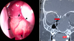 Bé trai 15 tháng tuổi bị lồi mắt, nghẹt mũi vì khối u lớn chèn ép. Ảnh: BVCC