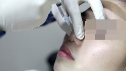 Ngưng tim nghi do phẫu thuật nâng mũi: Bệnh nhân đã tỉnh