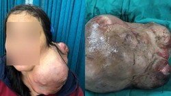 Bệnh viện Chợ Rẫy mổ tách thành công khối u nặng 3kg trên cổ bệnh nhân. Ảnh: BVCC