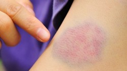 Vết bầm tím trên da cảnh báo bệnh gì?