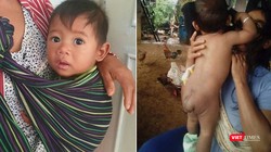Bé trai 7 tháng tuổi người dân tộc Châu Mạ mang khối u khổng lồ ở mông