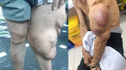 Cắt bỏ khối u sợi thần kinh khổng lồ khỏi cơ thể người đàn ông.