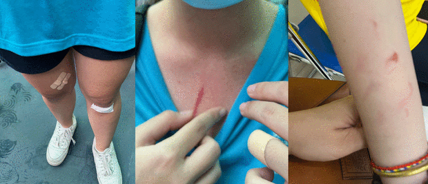 Một học sinh bị thương trong lúc xô xát Một học sinh bị thương trong lúc xô xát