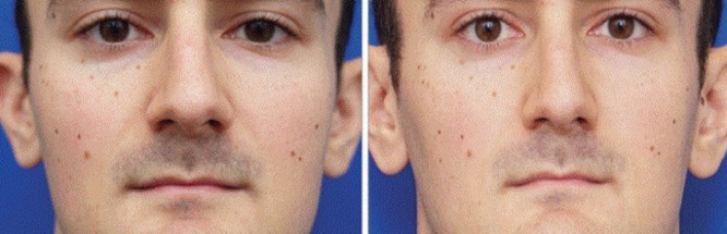 Chụp ảnh tự sướng nhiều sẽ làm mũi bị to ra? - ảnh 1