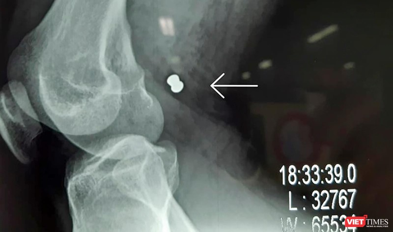 Phim X-ray chụp viên đạn ghim vào đùi gây vở động mạch và tĩnh mạch đùi của bạn nhân