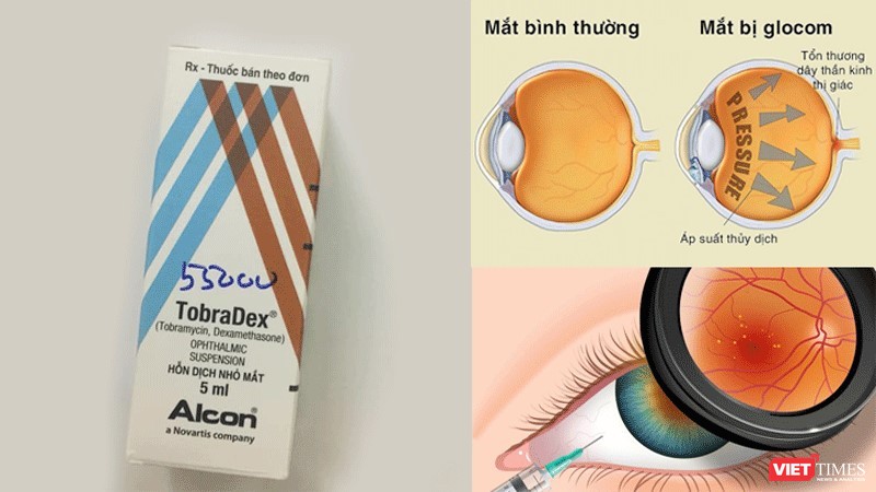 Tự ý sử dụng thuốc Tobradex, đôi mắt có thể bị tổn thương nặng, thậm chí mù lòa.