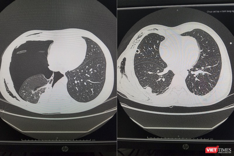 Phim chụp CT phổi của bệnh nhân trước và sau khi phẩu thuật